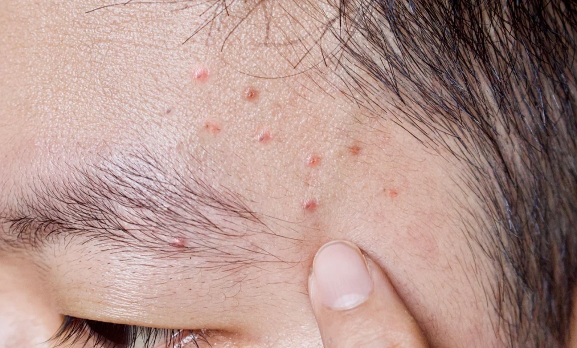 How Acne Treatment Works for Adult Acne Issues