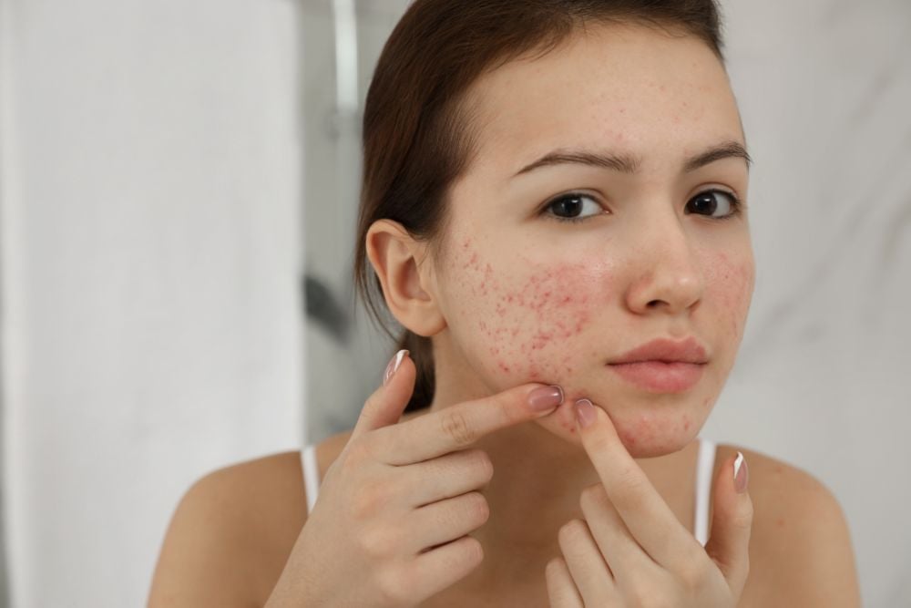 How Customized Is Acne Treatment for Individuals?