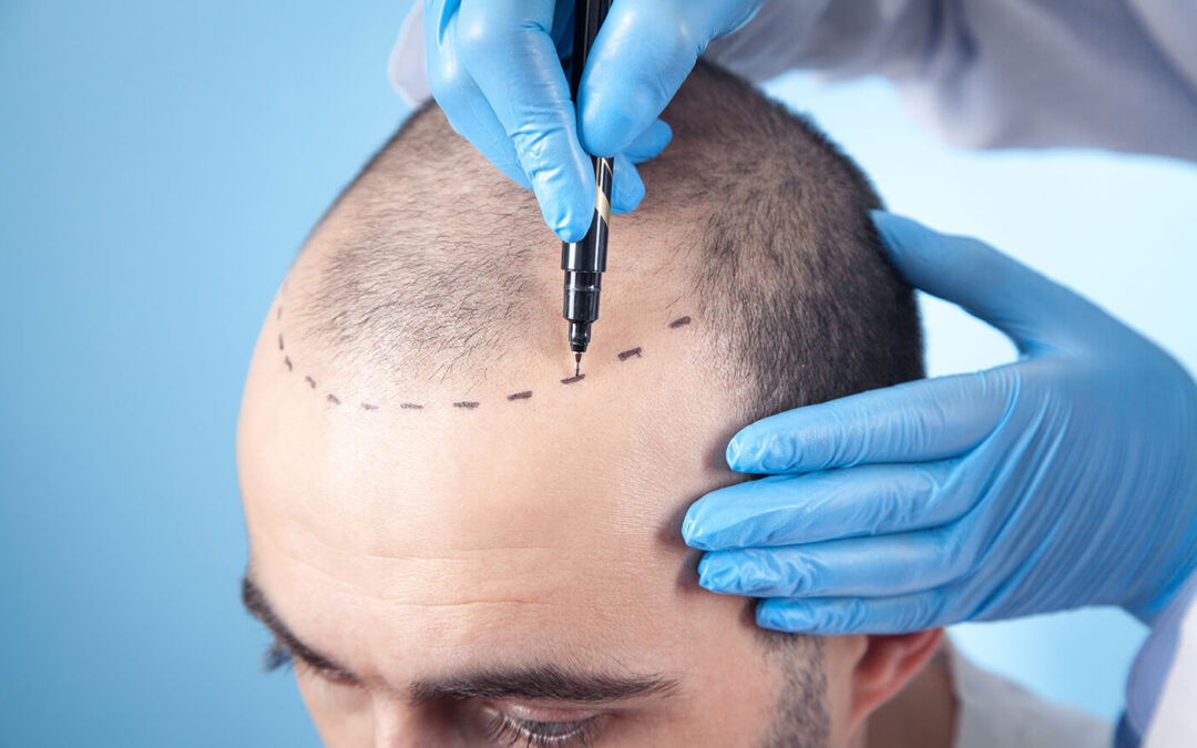 How Effective is FUE Hair Transplant for Balding Men?
