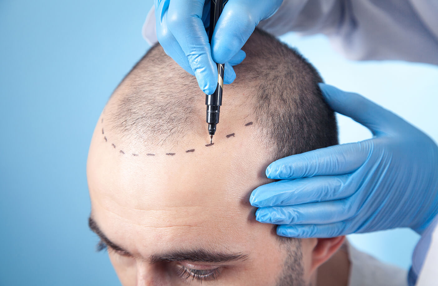 How Effective is FUE Hair Transplant for Balding Men