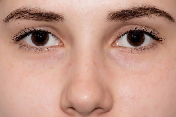How Eye Bag Removal  Restores Youthful Eyes
