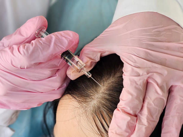How Hair PRP Can Boost Hair Density Fast