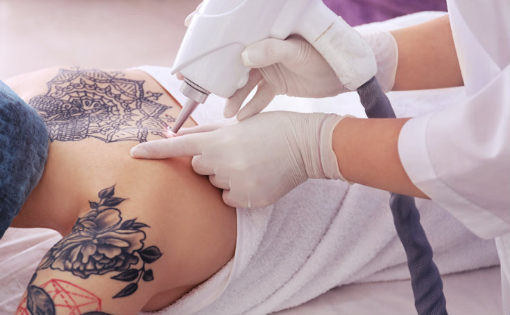 How Laser Tattoo Removal Helps Regain Clear Skin