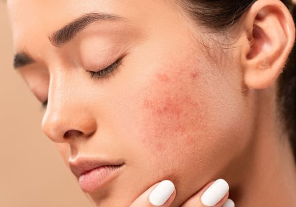 How Pimples Treatment Reduces Redness and Scarring