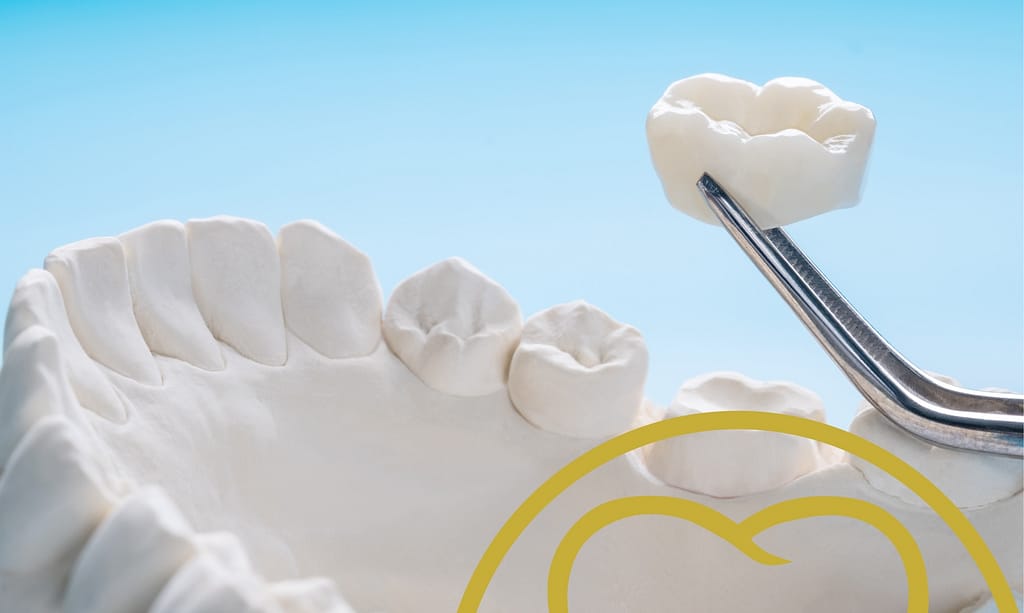 How Zirconia Crowns Help in Restoring Cracked Teeth