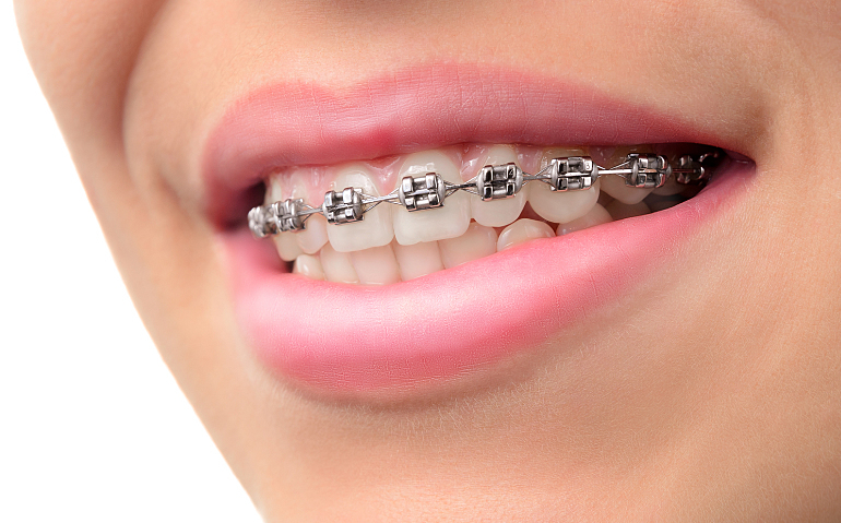 How to Keep Smiling Through the Discomfort of Braces