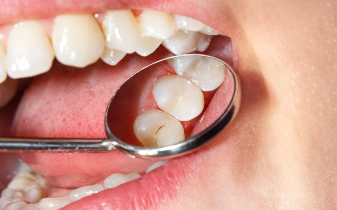 How to Prevent Cavities and Reduce the Need for Fillings