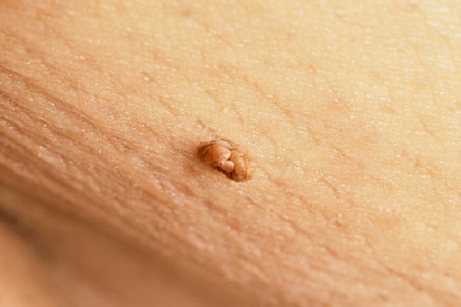 How to Remove Skin Tags on the Inner Thigh DIY Tips and Tricks