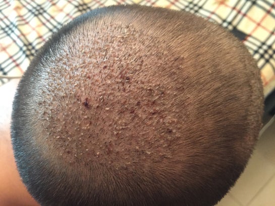 Is Hair Transplant Cost Lower with Seasonal Offers?