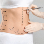 Liposuction surgery