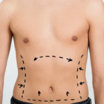 Liposuction surgery in Dubai