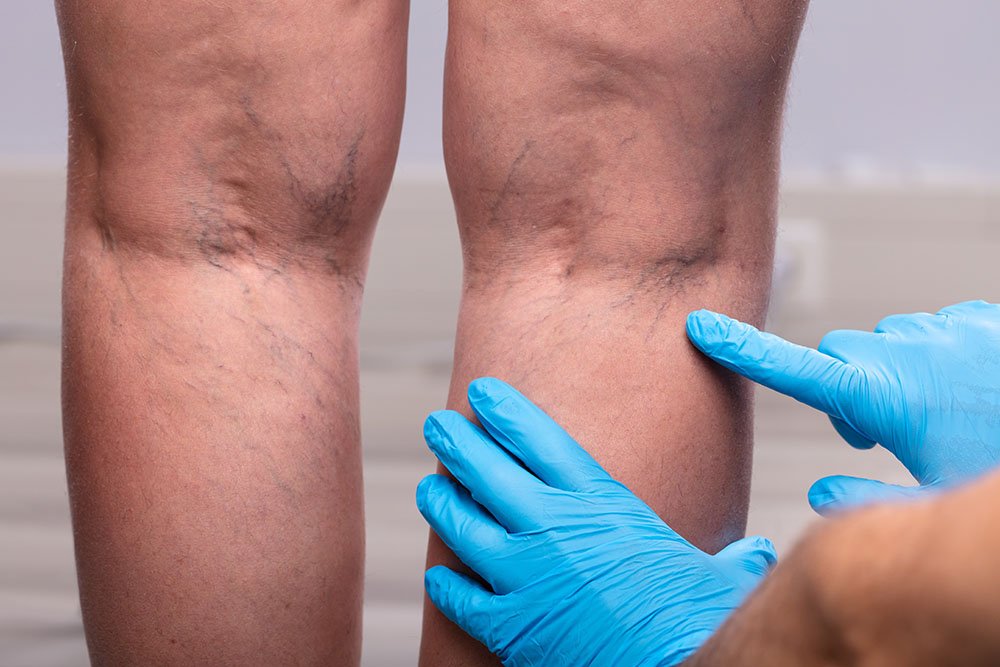 Minimally Invasive Vein Treatments Sclerotherapy