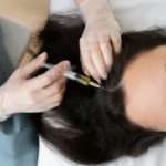 PRP Hair Treatment in Dubai
