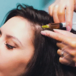 PRP Hair Treatment in Dubai 