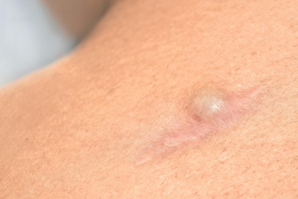 Patient Experiences with Lipoma Removal