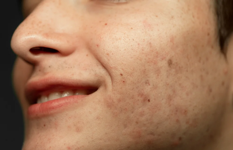 Pigmentation Treatment Affordable Options That Deliver Results