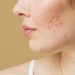 Pimples Treatment in Dubai