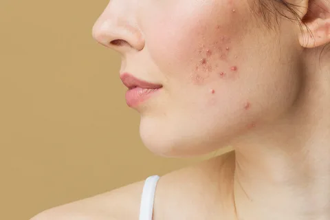 Transform Your Skin and Confidence with Pimples Treatment in Dubai