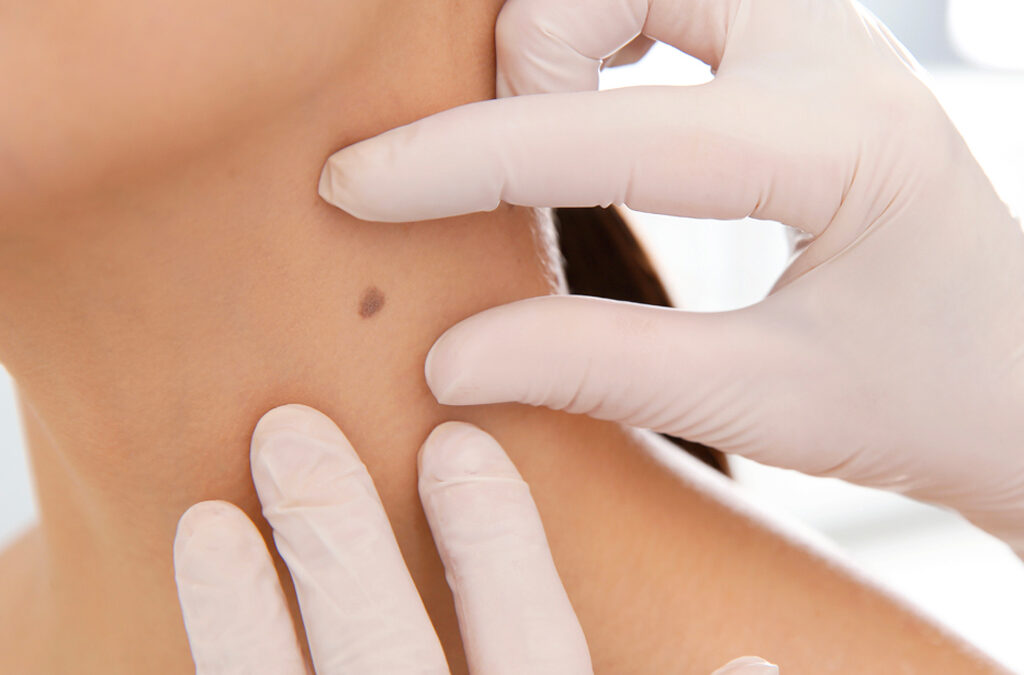 Professional Skin Lesion Removal Services