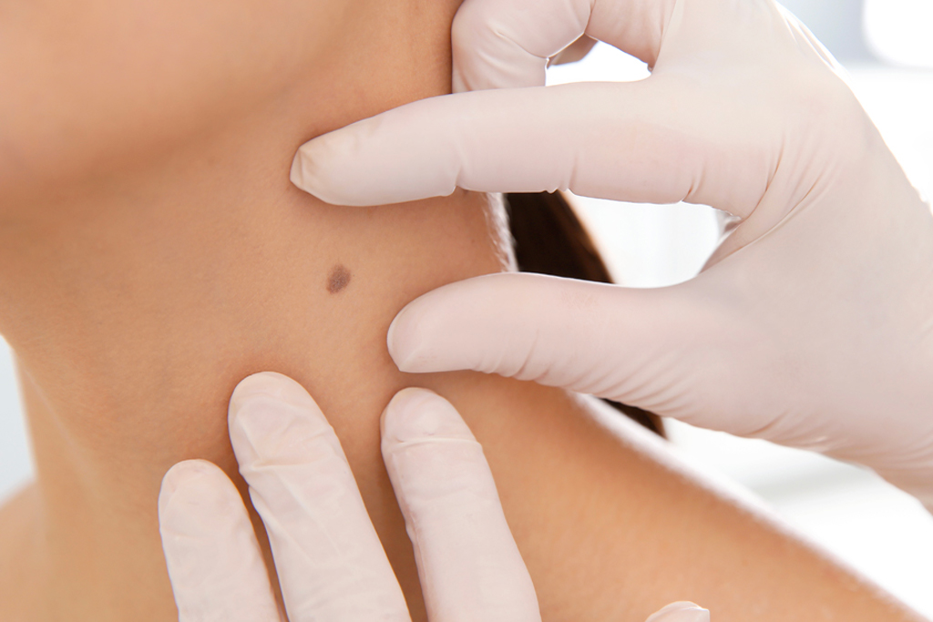 Professional Skin Lesion Removal Services