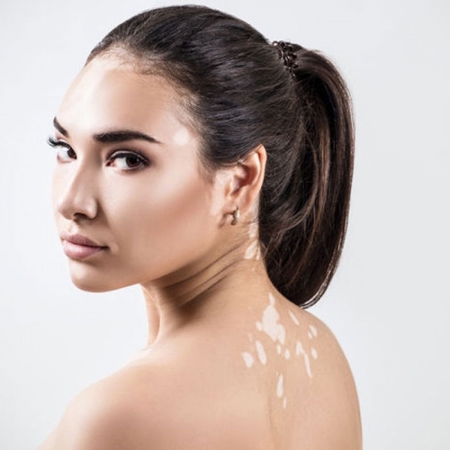 Psychological and Cosmetic Support for Vitiligo