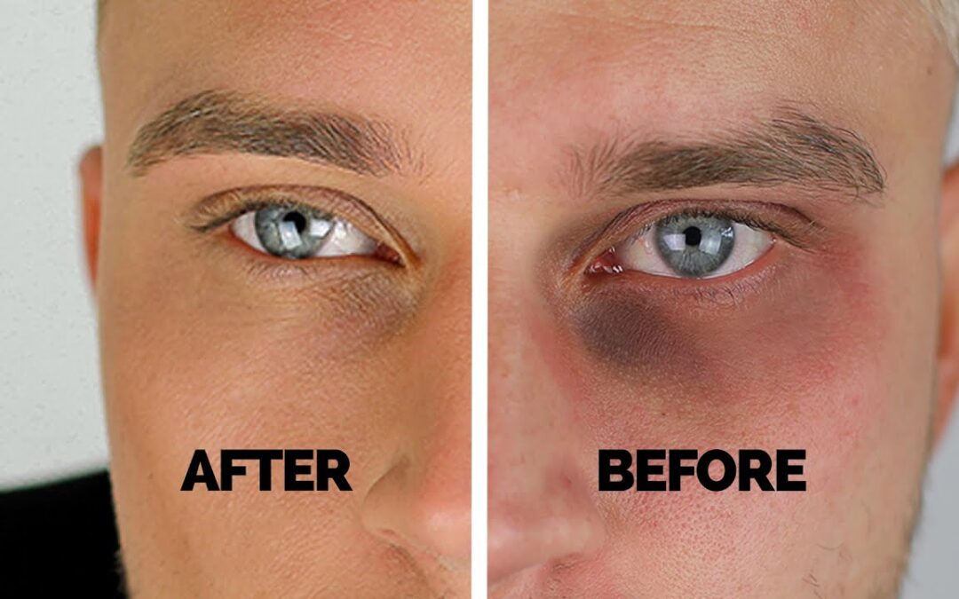 Can Diet Help Reduce Dark Circles Under Eyes?