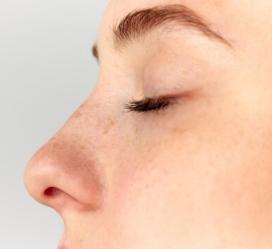 Ethnic Rhinoplasty in Islamabad: Preserving Natural Beauty