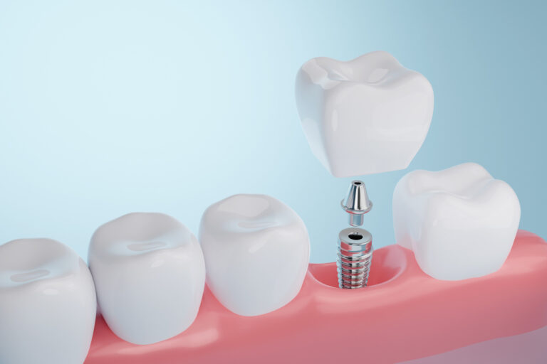 Root Canal Treatment Recovery Timeline From Day One to Healing