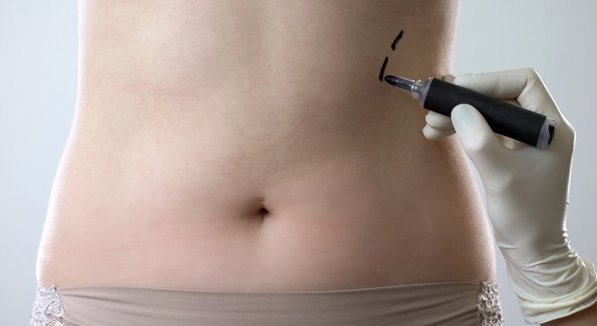 Sculpt Your Ideal Physique with Vaser 4D Liposuction