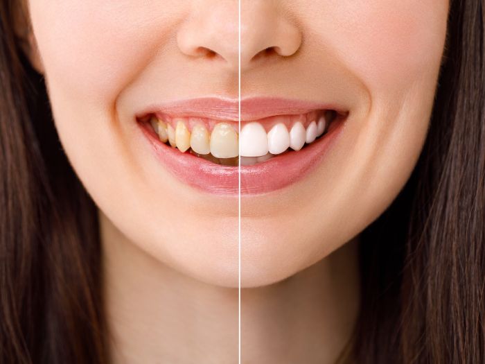 The Difference Between Whitening Toothpaste and Professional Whitening