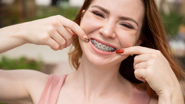 The Psychological Benefits of Straightening Your Teeth