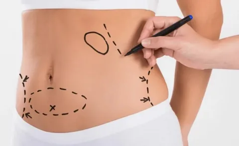 Understanding the Value and Cost of a Tummy Tuck Surgery in Dubai