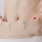 Tummy Tuck Surgery in Dubai img
