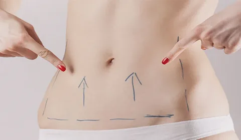 Tummy Tuck Surgery in Dubai img