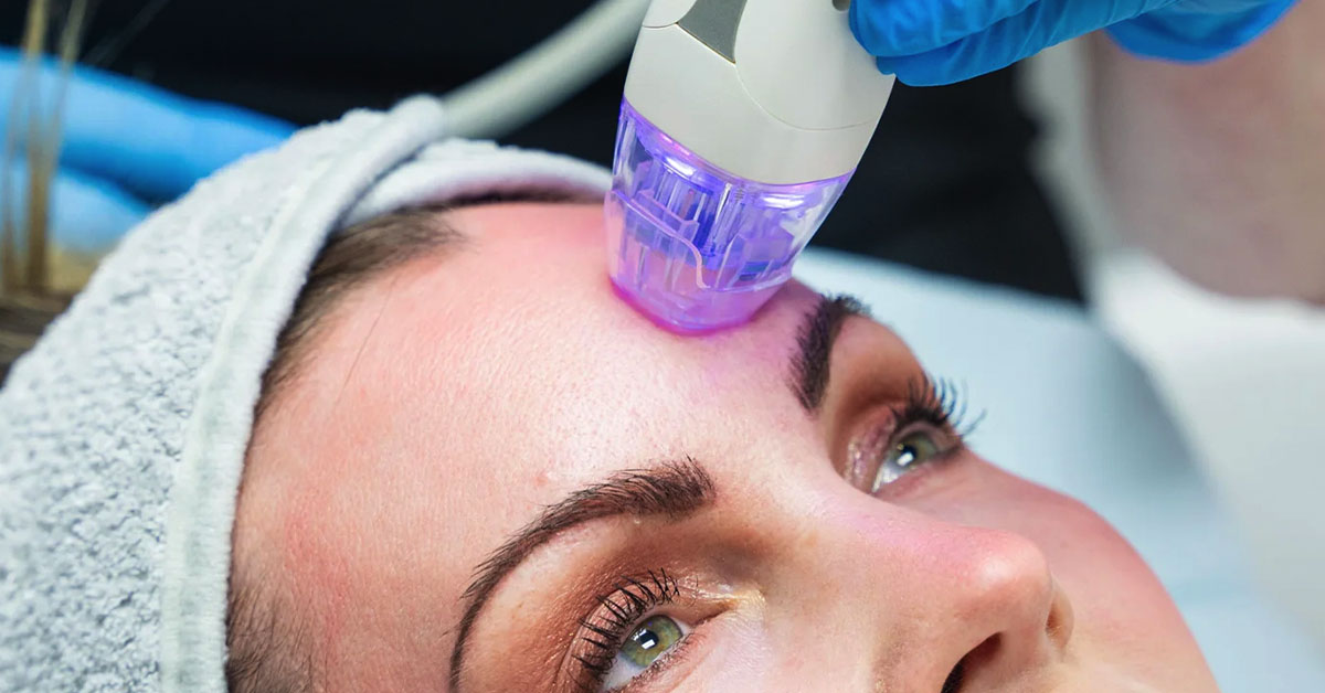 Understanding Microneedling Why Dermapen Is Leading the Way