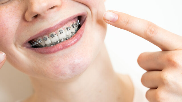 Why Metal Braces Are Still the Most Reliable Orthodontic Option