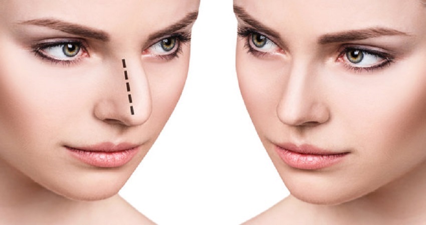 تكلفة عملية تجميل الأنف في الرياض: كم تبلغ؟