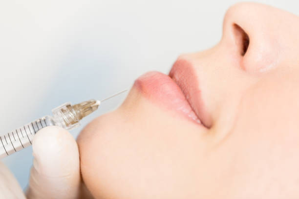 Botox Lipflip in Riyadh 