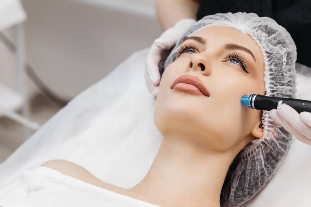 Can Dermapen Microneedling Improve Stretch Marks