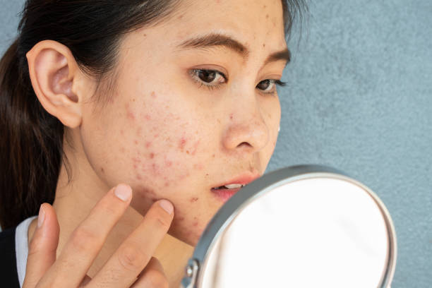 Can Laser Acne Scar Treatment Fix Enlarged Pores