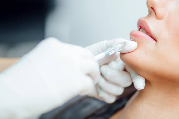 Can Lip Fillers Improve Dry and Wrinkled Lips