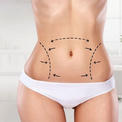 Can Liposuction Remove Fat Without Scarring