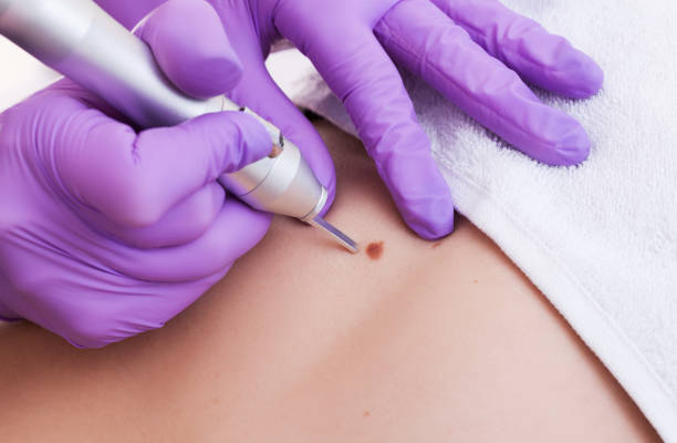 Can Mole Removal Improve Skin Appearance Quickly