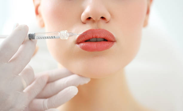 Can Russian Lip Fillers Correct Lip Volume Loss