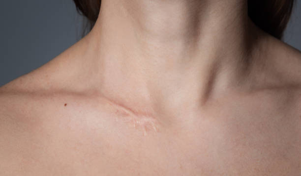 Can Surgical Scar Revision Fix Discolored Scars Too