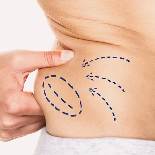 How Much Swelling Happens After Fat Dissolving Injections?