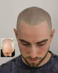Cover bald spots with precision