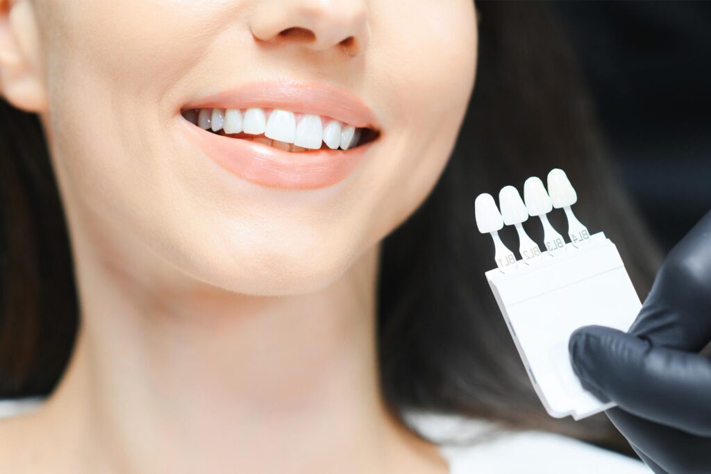 Customizing Composite Veneers Matching Shape and Shade to Your Face