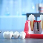 Invisalign Hasting