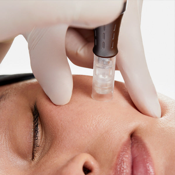 Dermapen revives dull, tired-looking skin.